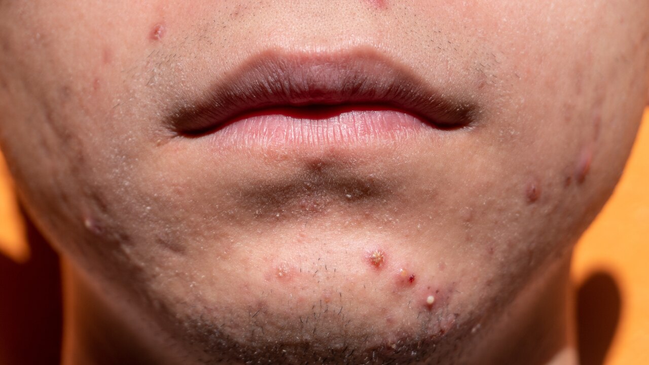 5. Chin & Jawline – Hormones & Digestive/Elimination Systems