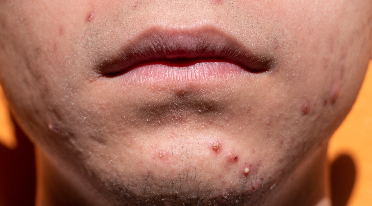 5. Chin & Jawline – Hormones & Digestive/Elimination Systems