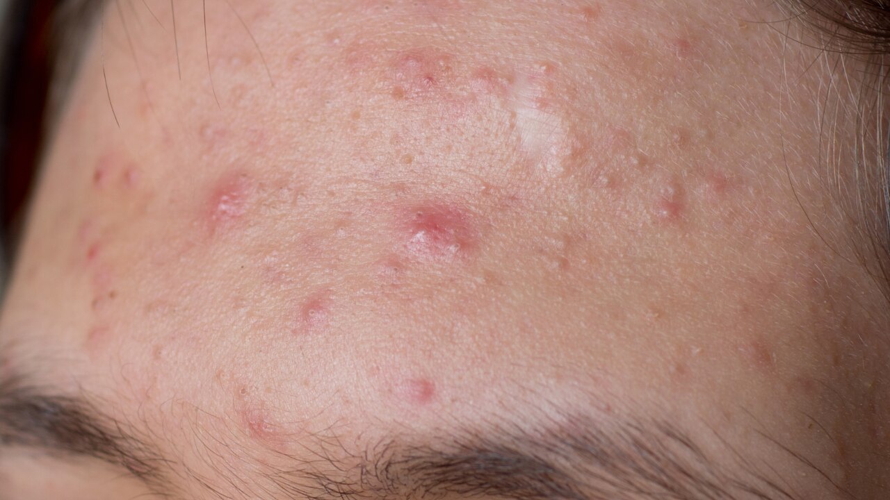 Forehead ­— Linked to Digestion and Stress