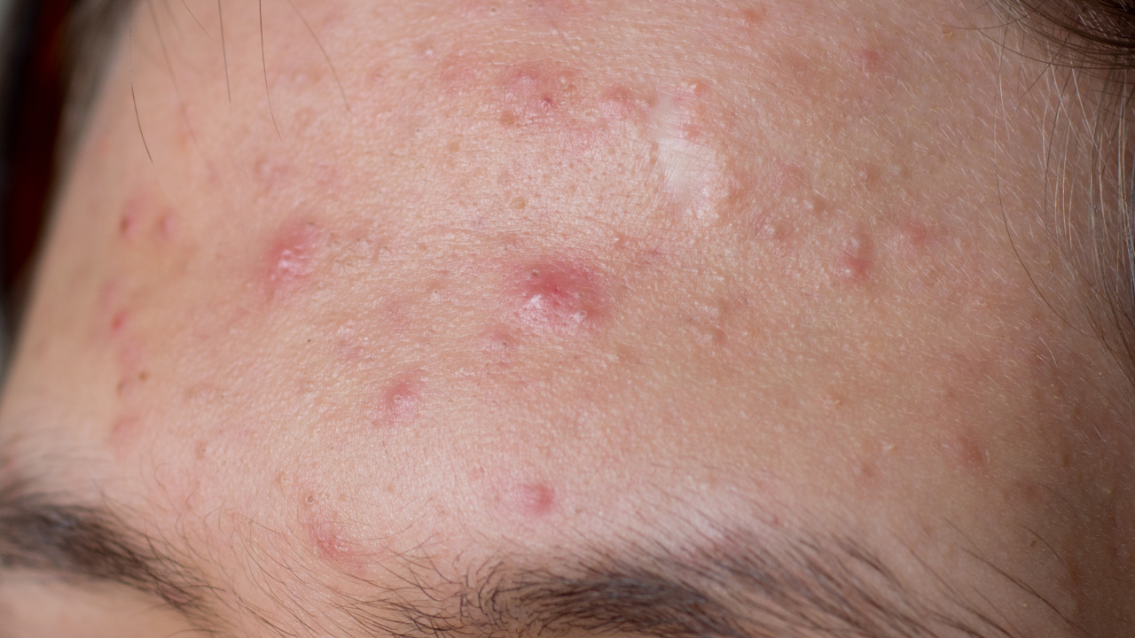 Forehead — Linked to Digestion and Stress