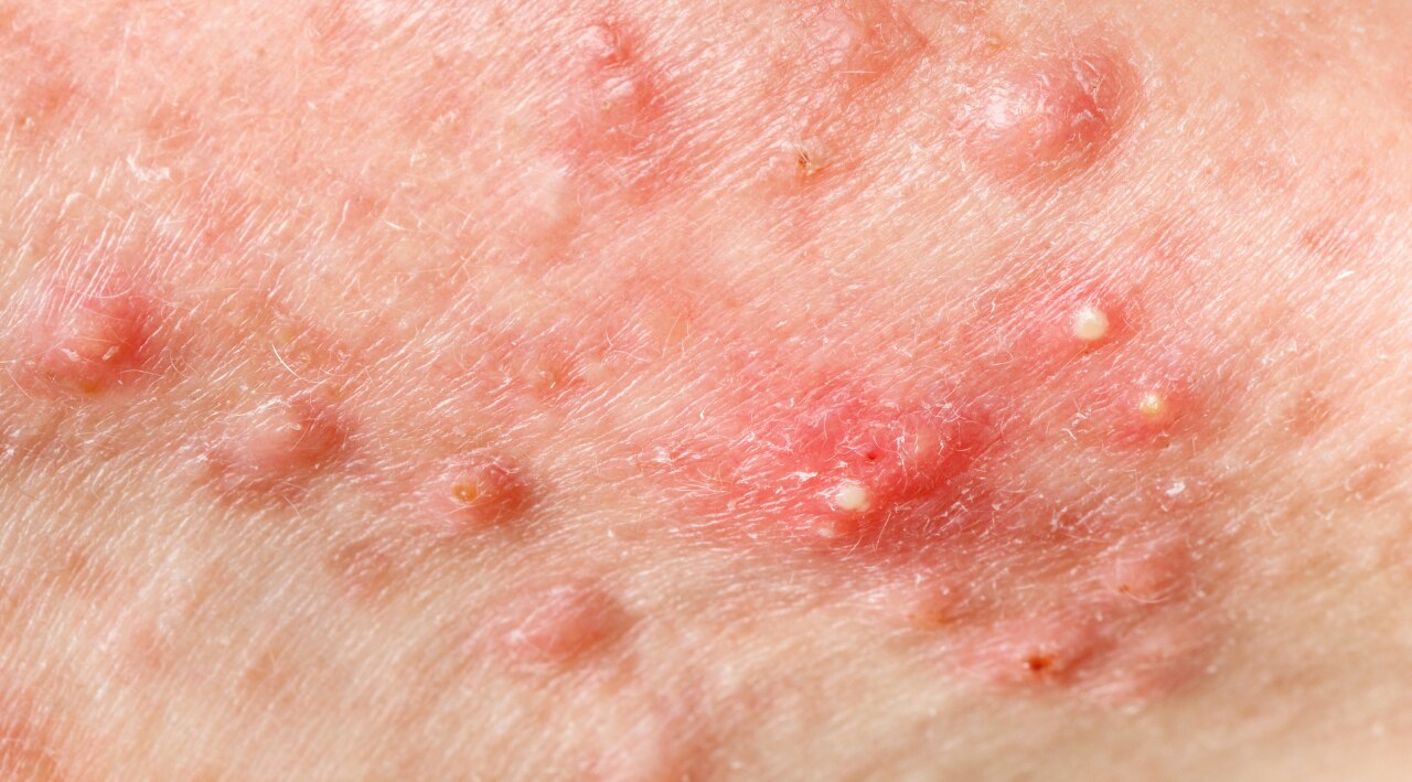 How Accurate Is Face Mapping for Acne?