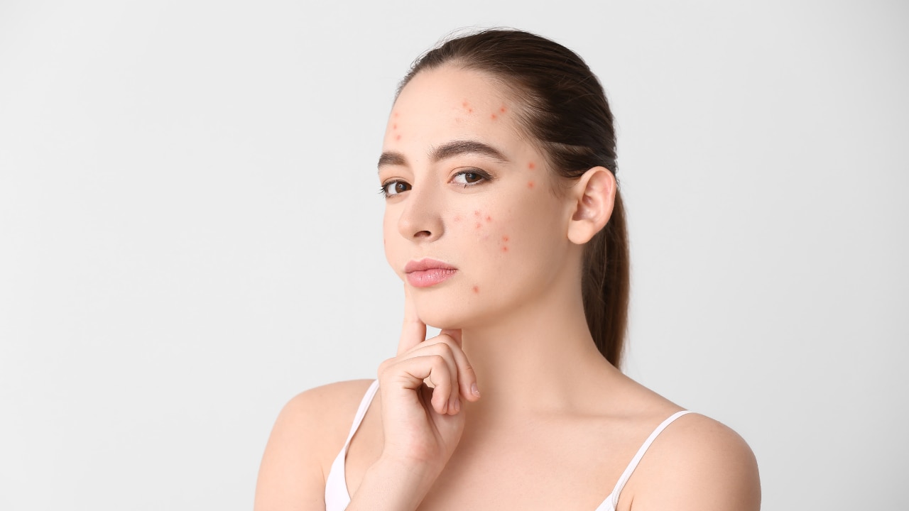 How to Treat Acne According to the Face Map