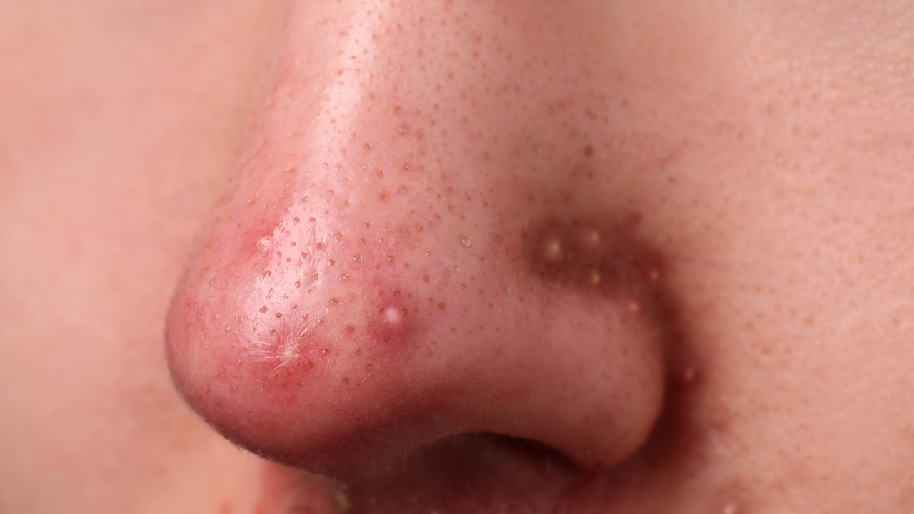 Nose & Upper Lip – Oil Production, Liver & Heart