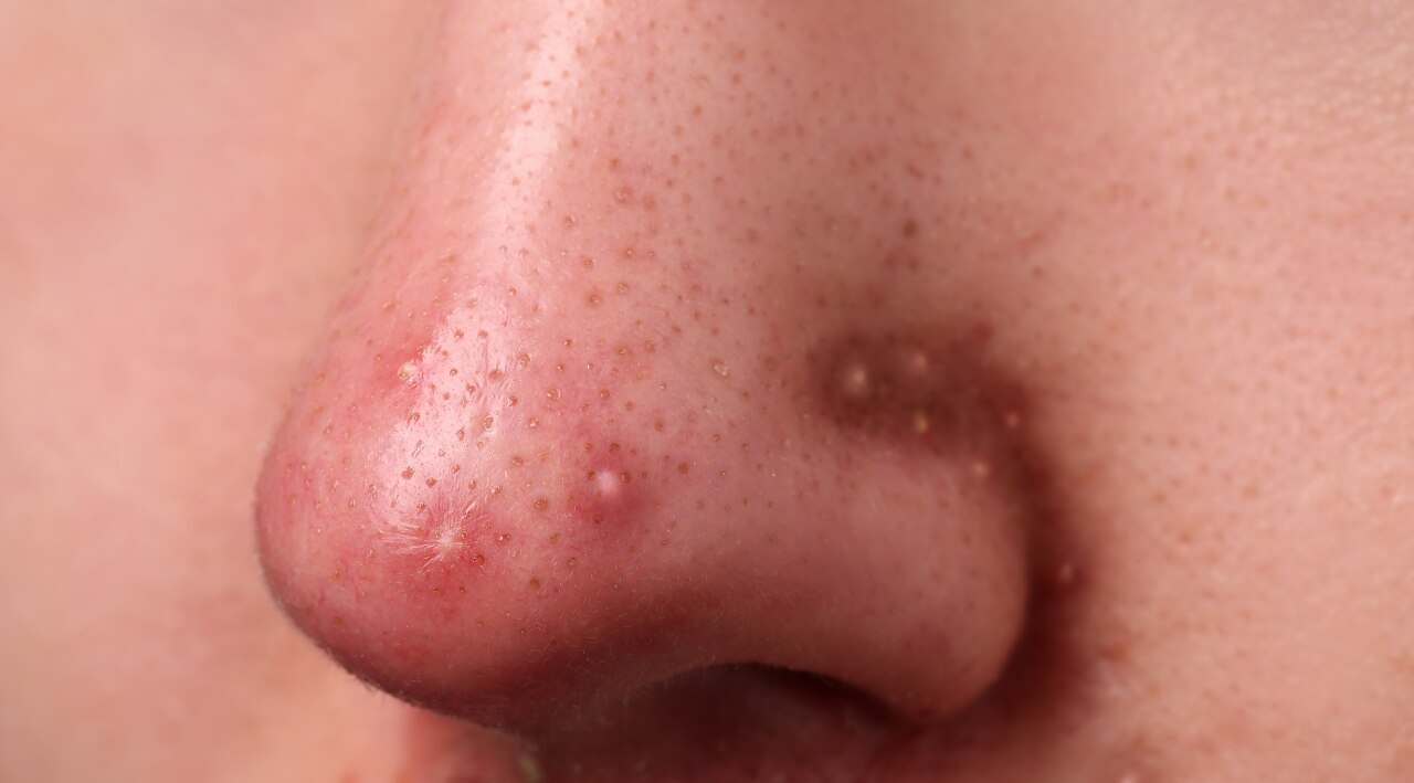 Nose & Upper Lip – Oil Production, Liver & Heart