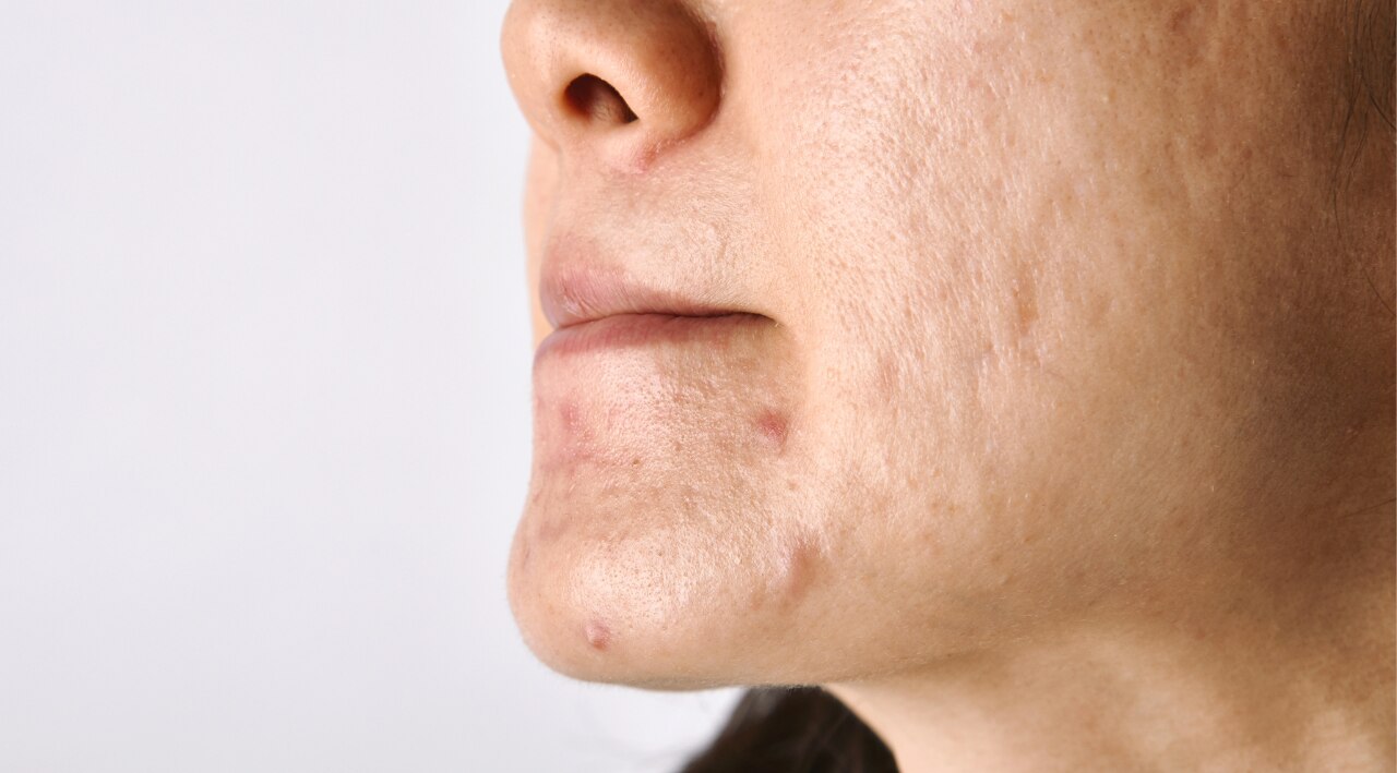 Fades Pigmentation and Dark Spots: