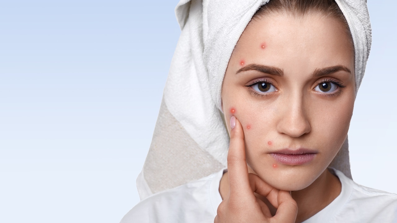 Acne and Pimple Management: