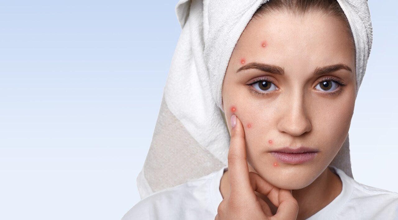 Acne and Pimple Management: