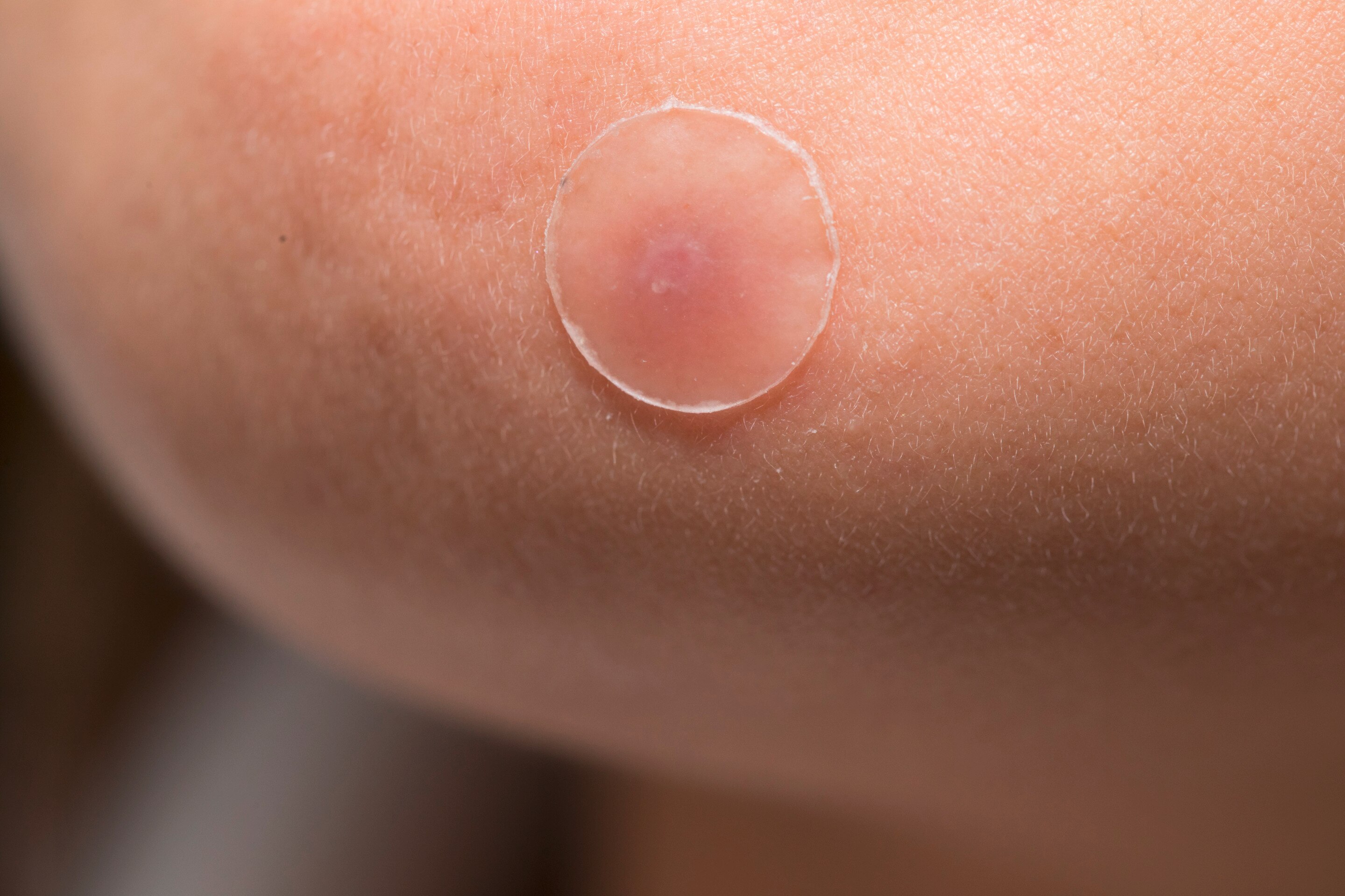 Closeup of pimple covered with pimple patch.