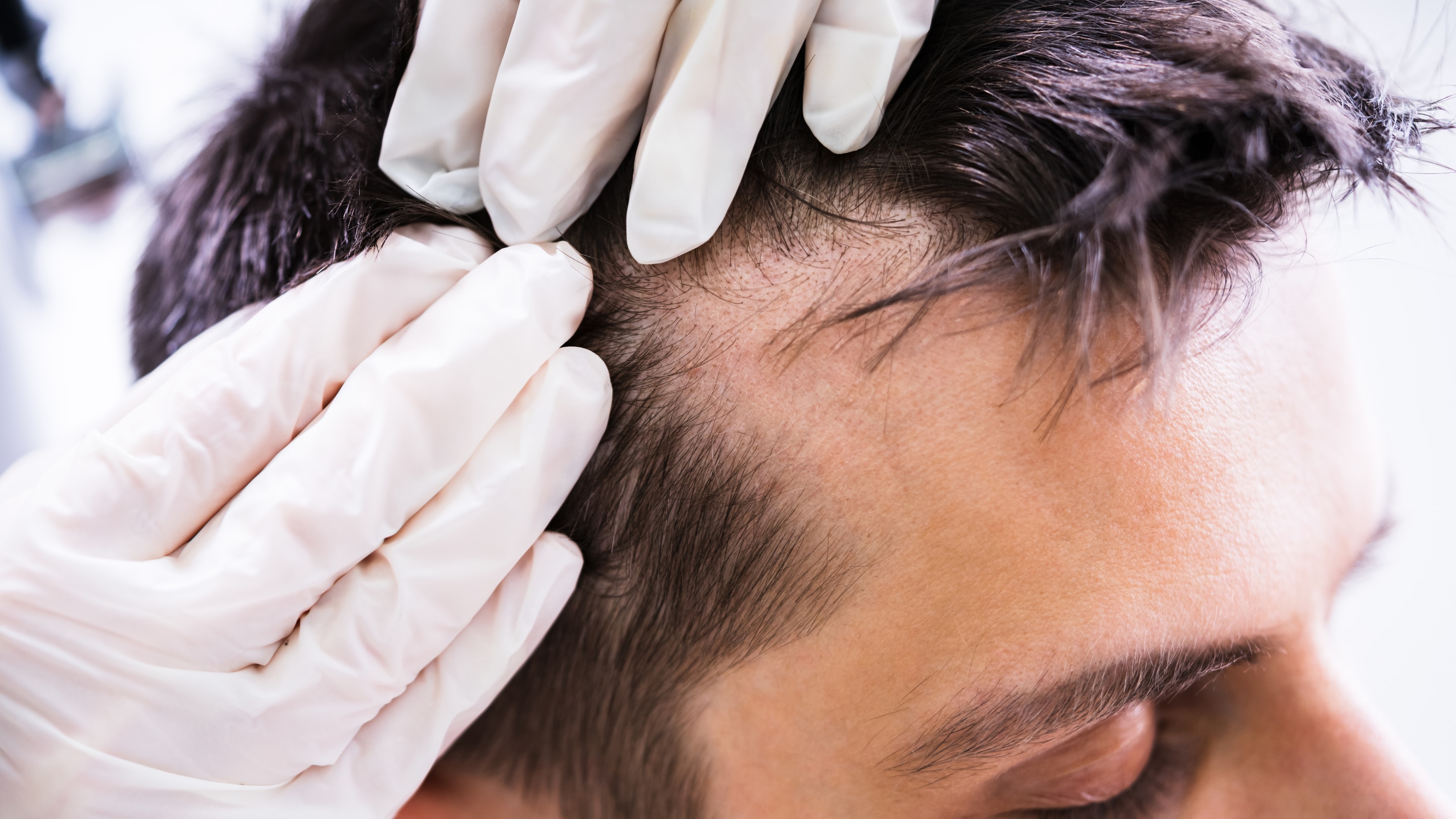 Causes of  Hair Fall in Men