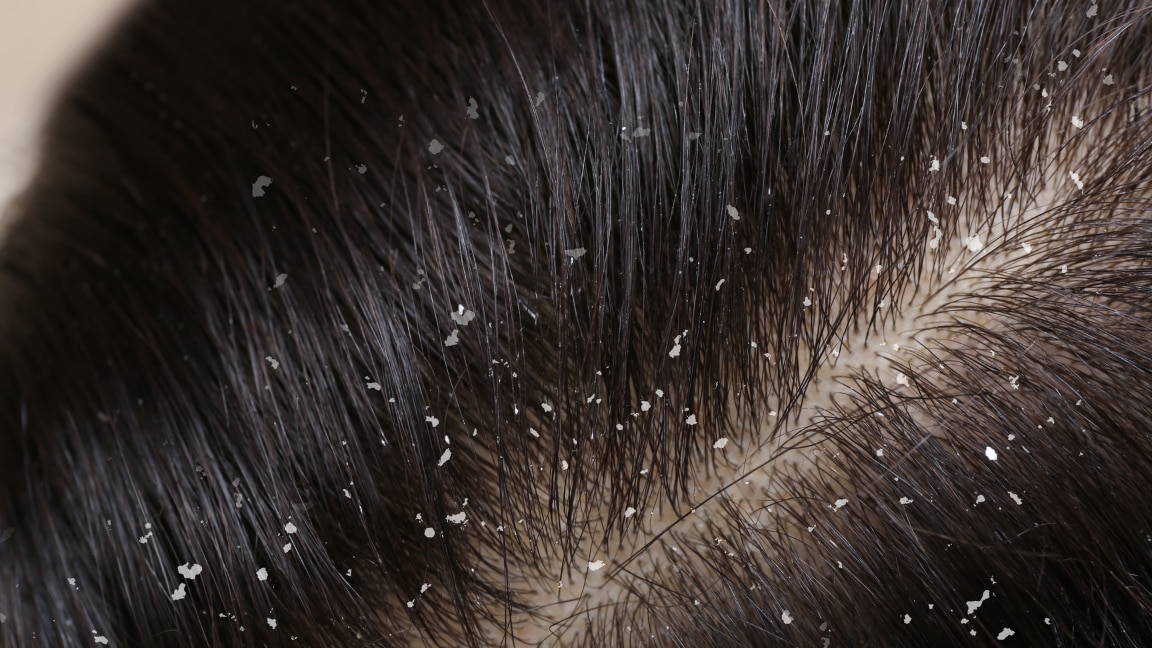 linking article: How to Remove Dandruff Easily: Easy Natural Tips for a Flake-Free Scalp