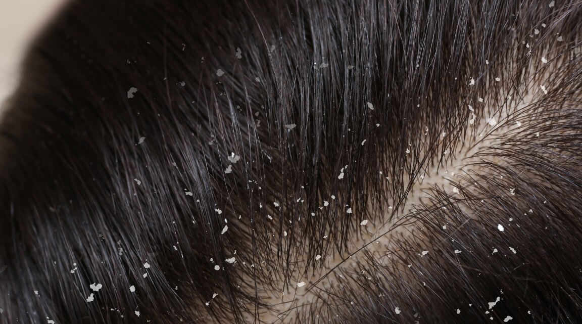 Natural Remedies to Remove Dandruff from Hair and Scalp