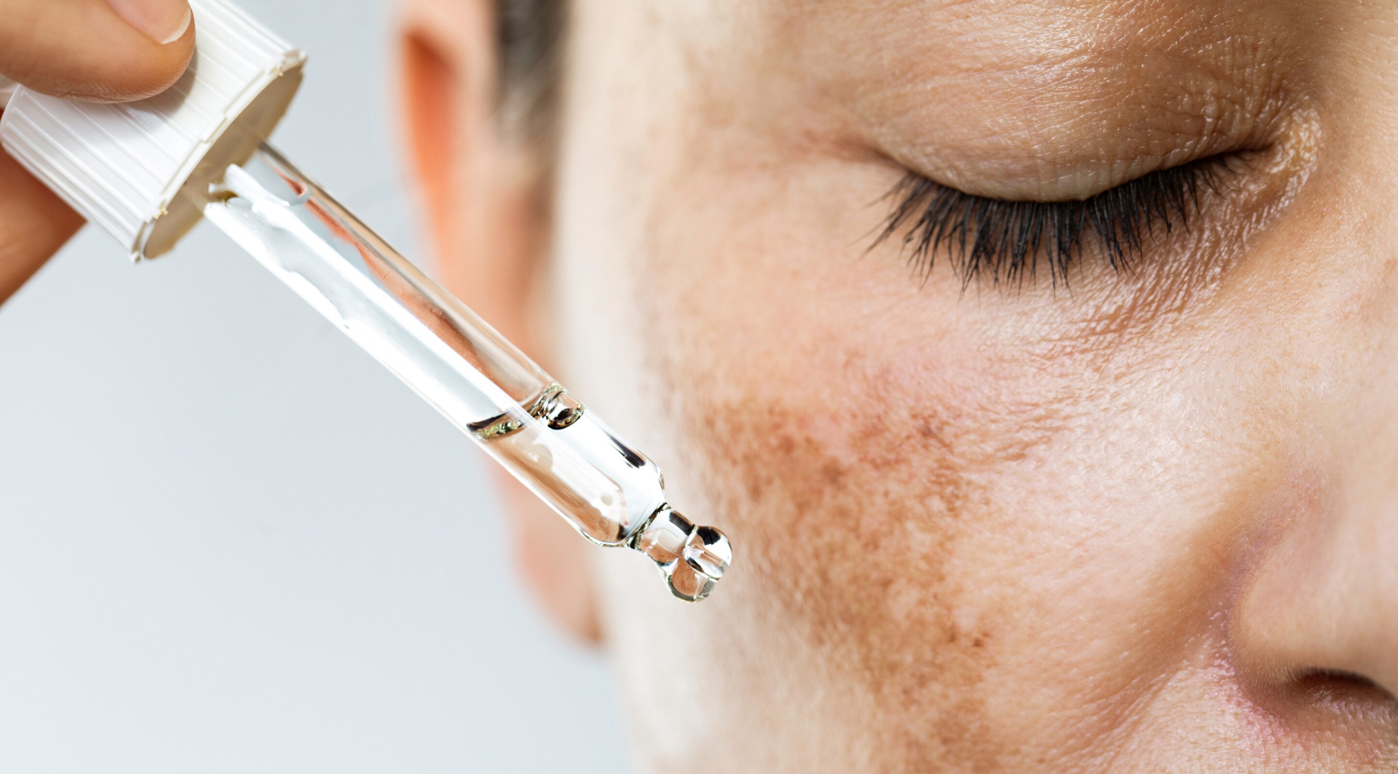 Treating Hyperpigmentation: