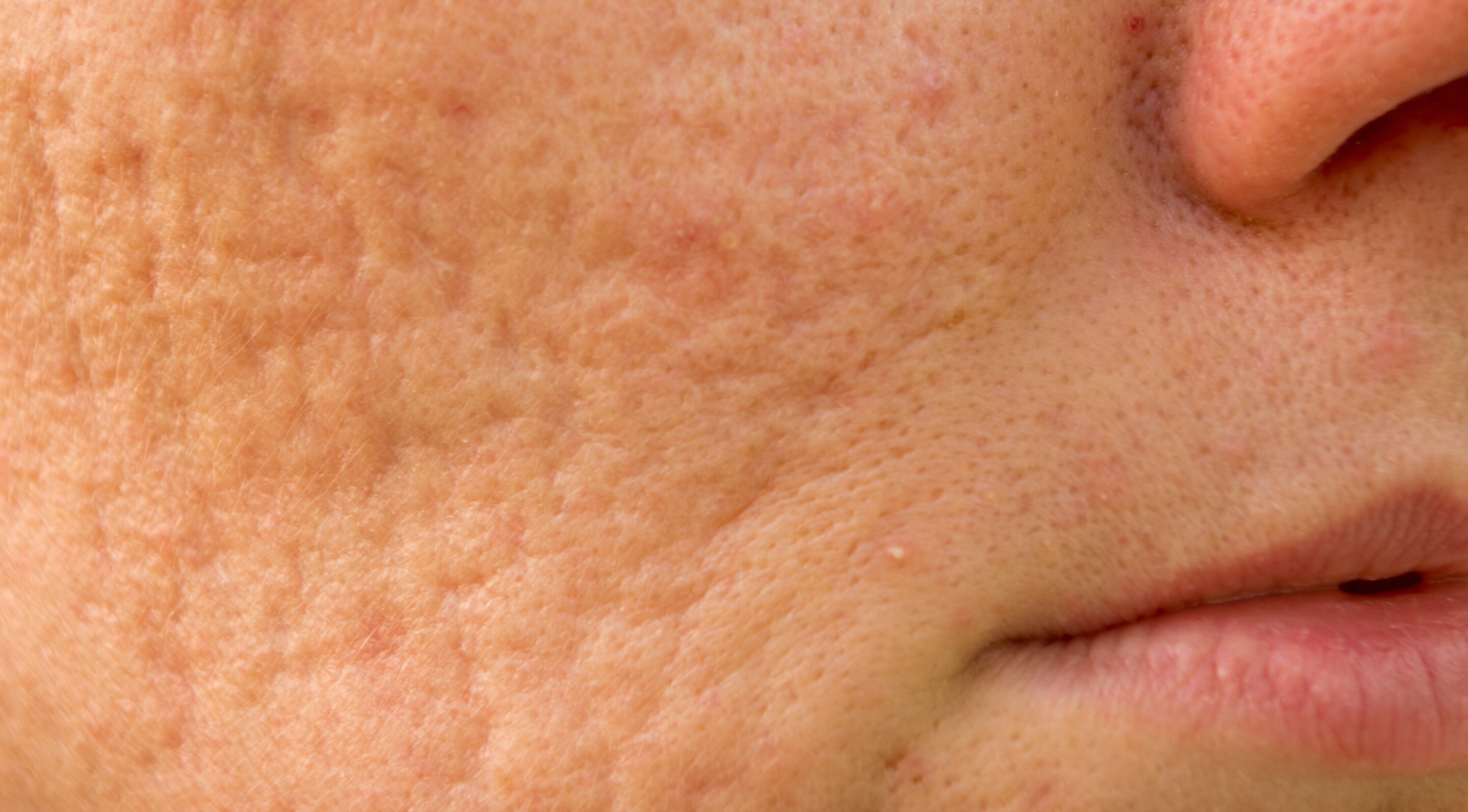 Reducing Acne Scars (Post-Inflammatory Hyperpigmentation):