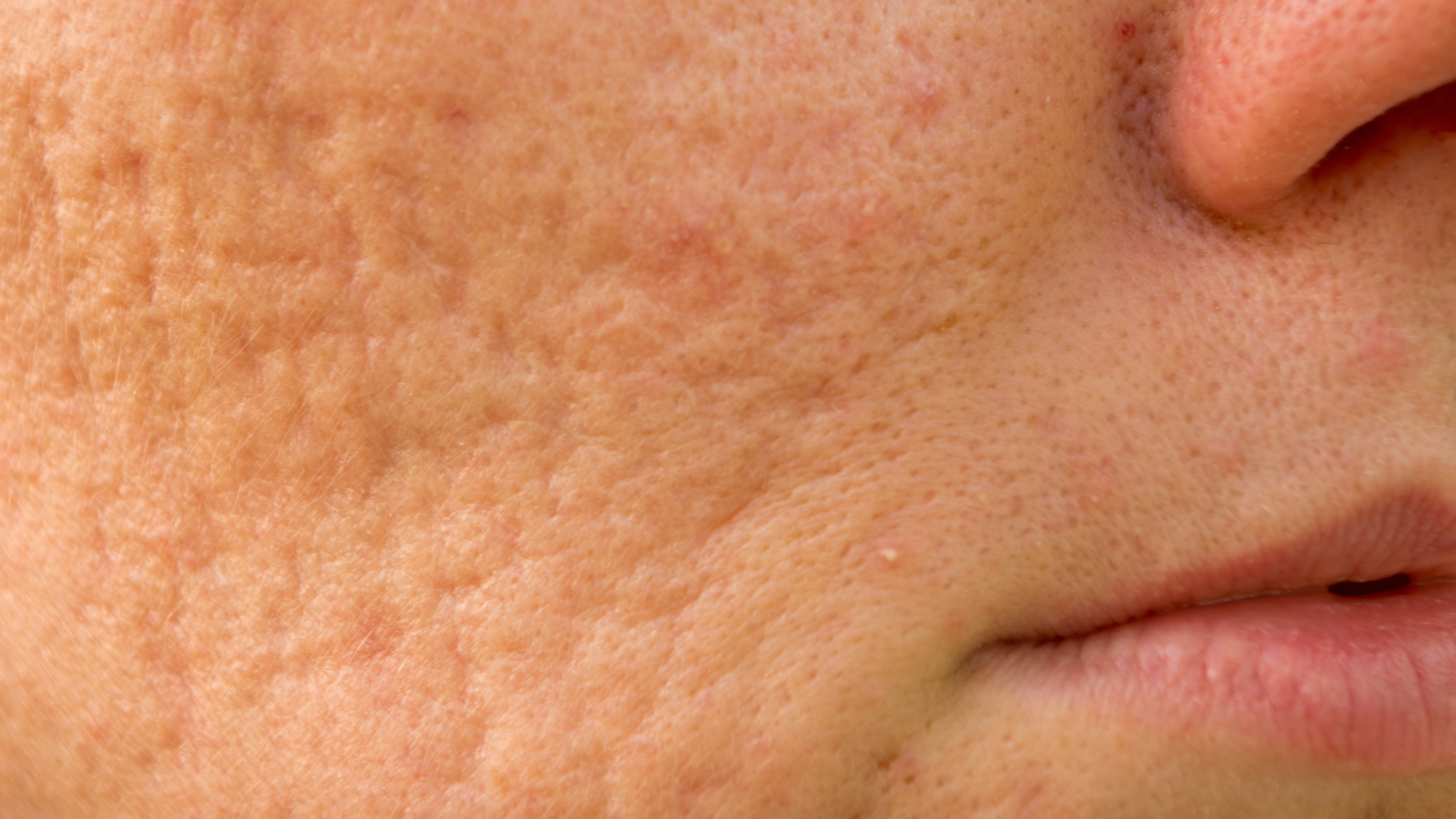 Reducing Acne Scars (Post-Inflammatory Hyperpigmentation):