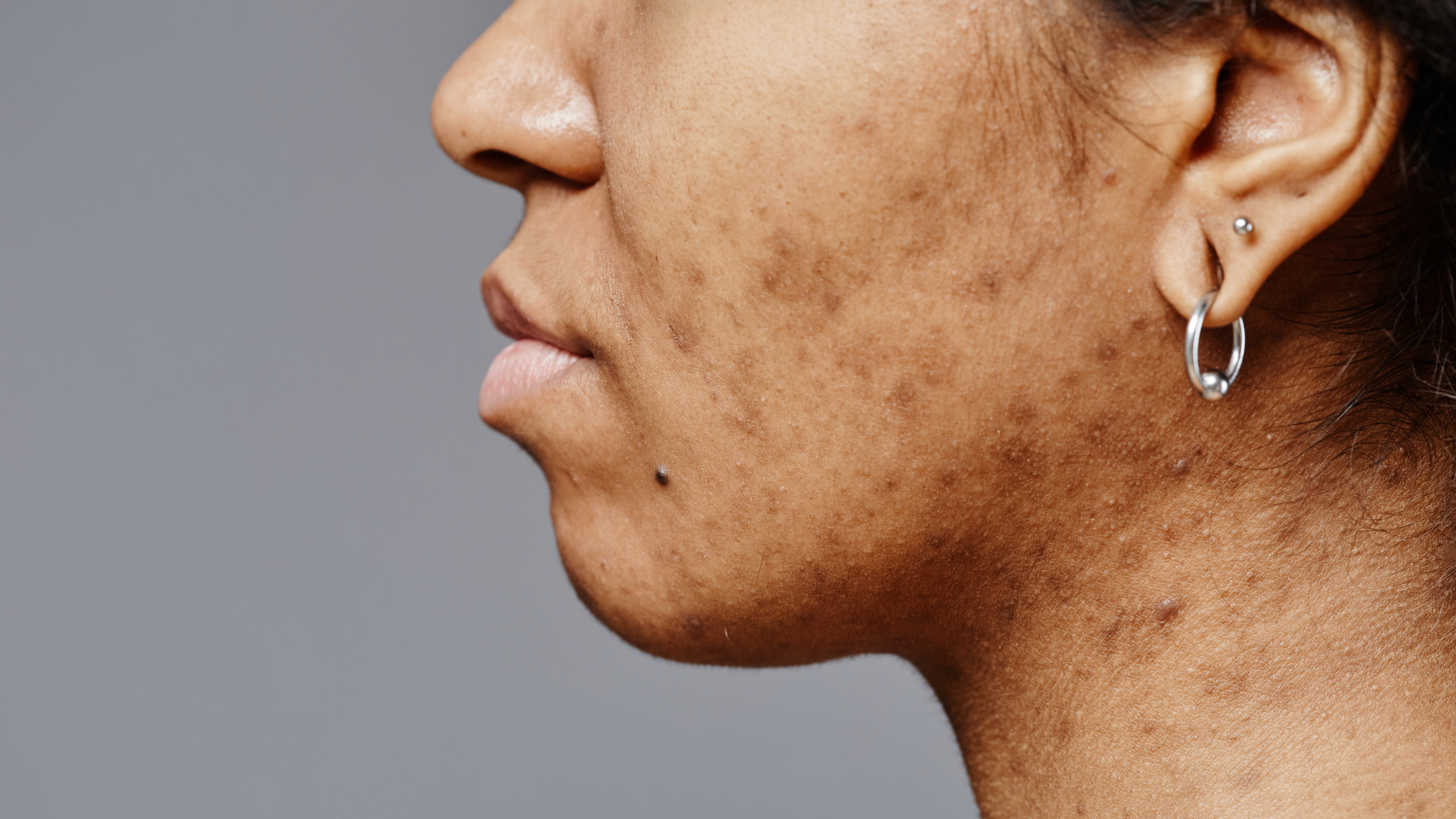 Minimising Melasma: