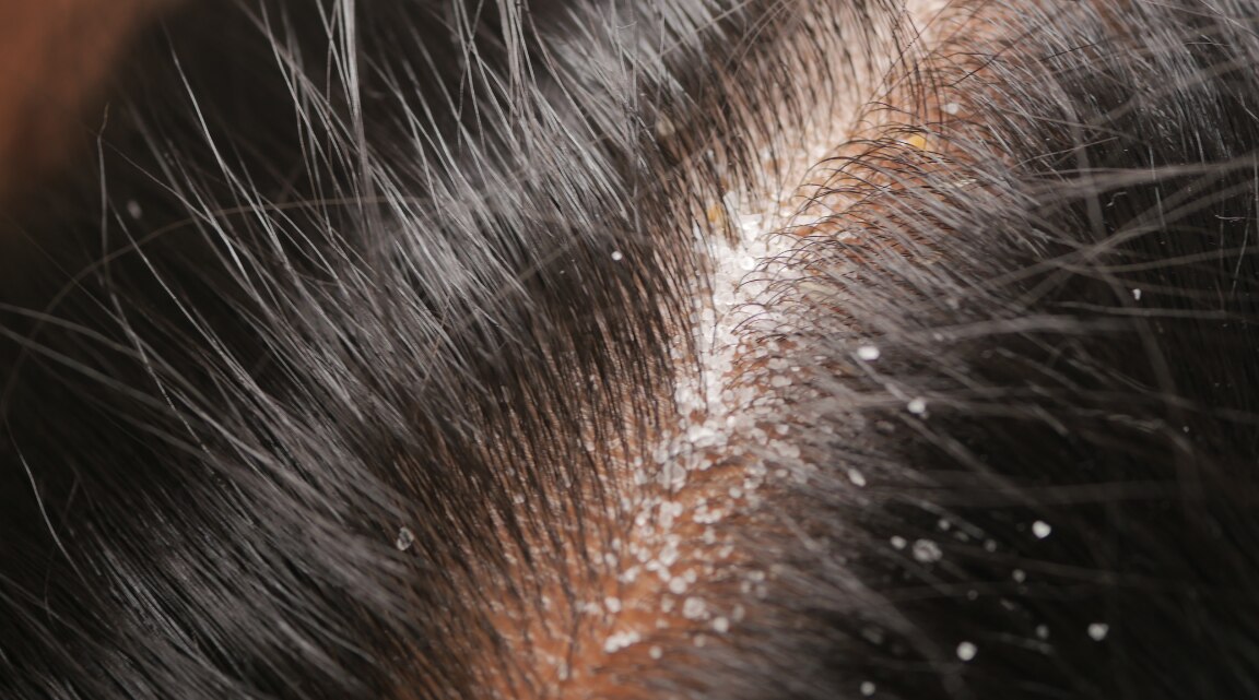 Close-up of dry flaky scalp before and after treatment