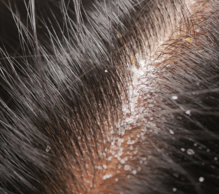 Image of Dry Flaky Scalp: Causes, Treatments & Effective Home Remedies
