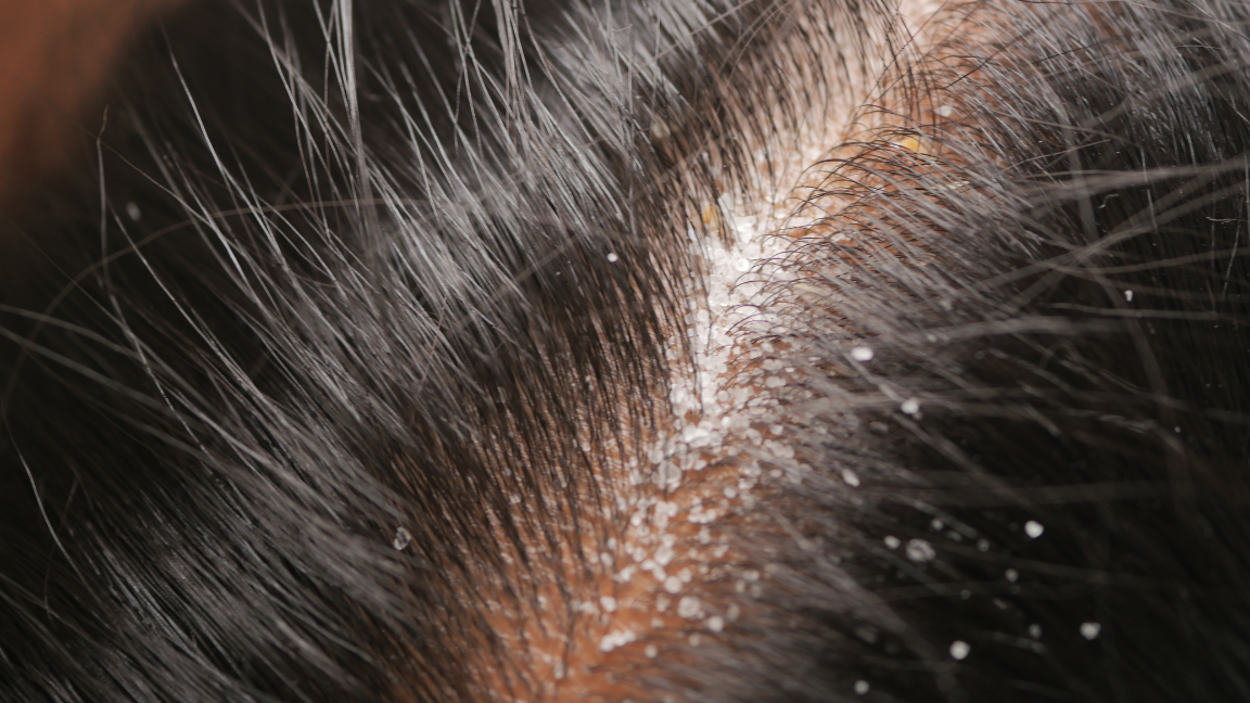 Close-up of dry flaky scalp before and after treatment