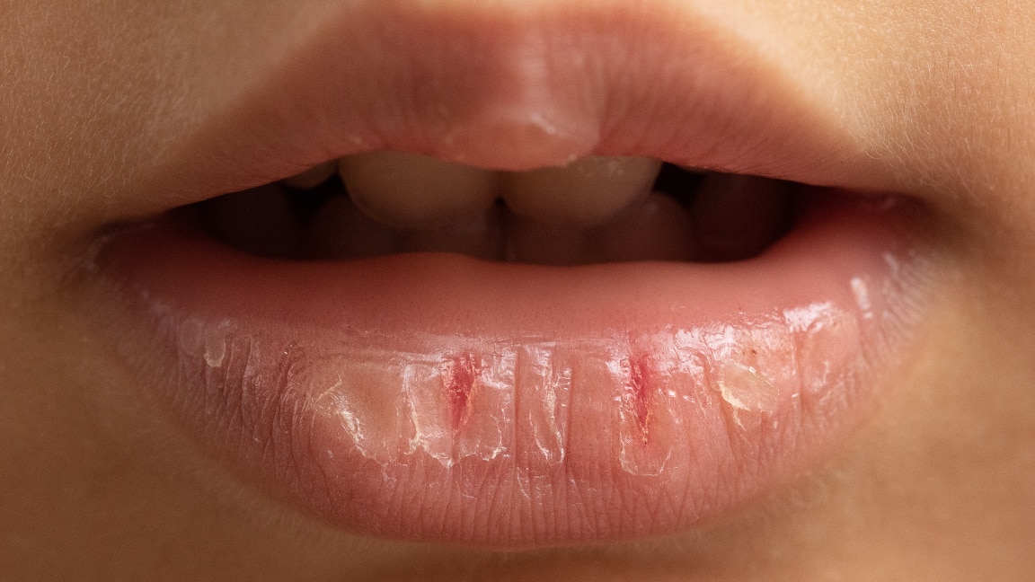 linking article: Chapped Lips: Causes, Treatments & How to Cure Them Fast