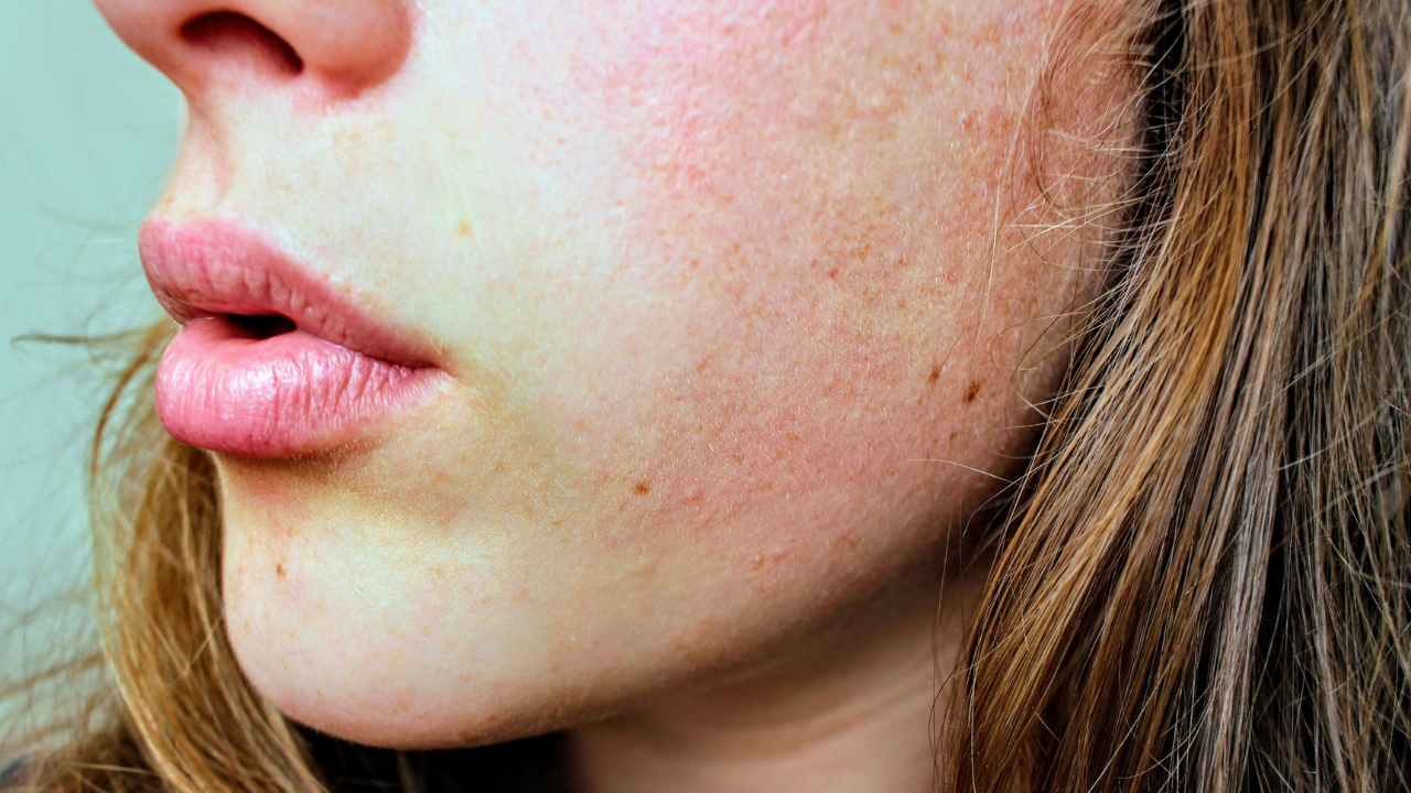 Causes of Chapped Lips