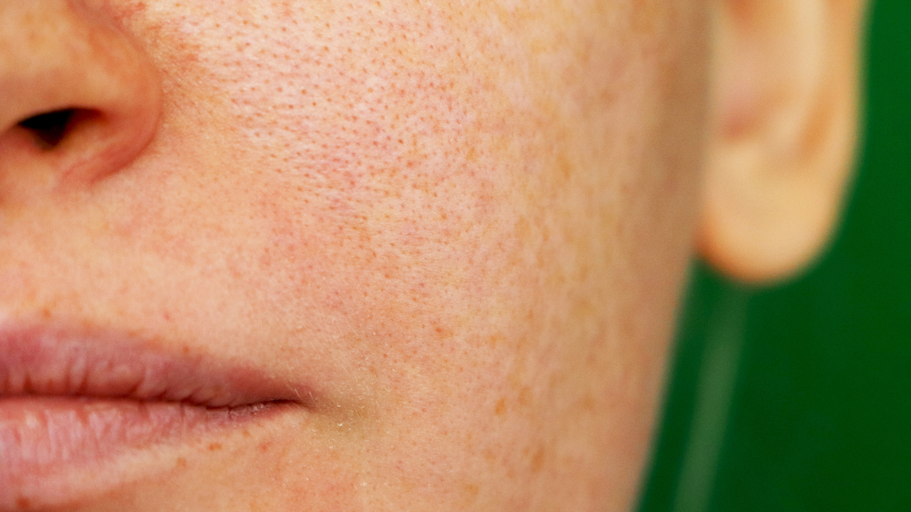 Reduces Hyperpigmentation and Blemishes: