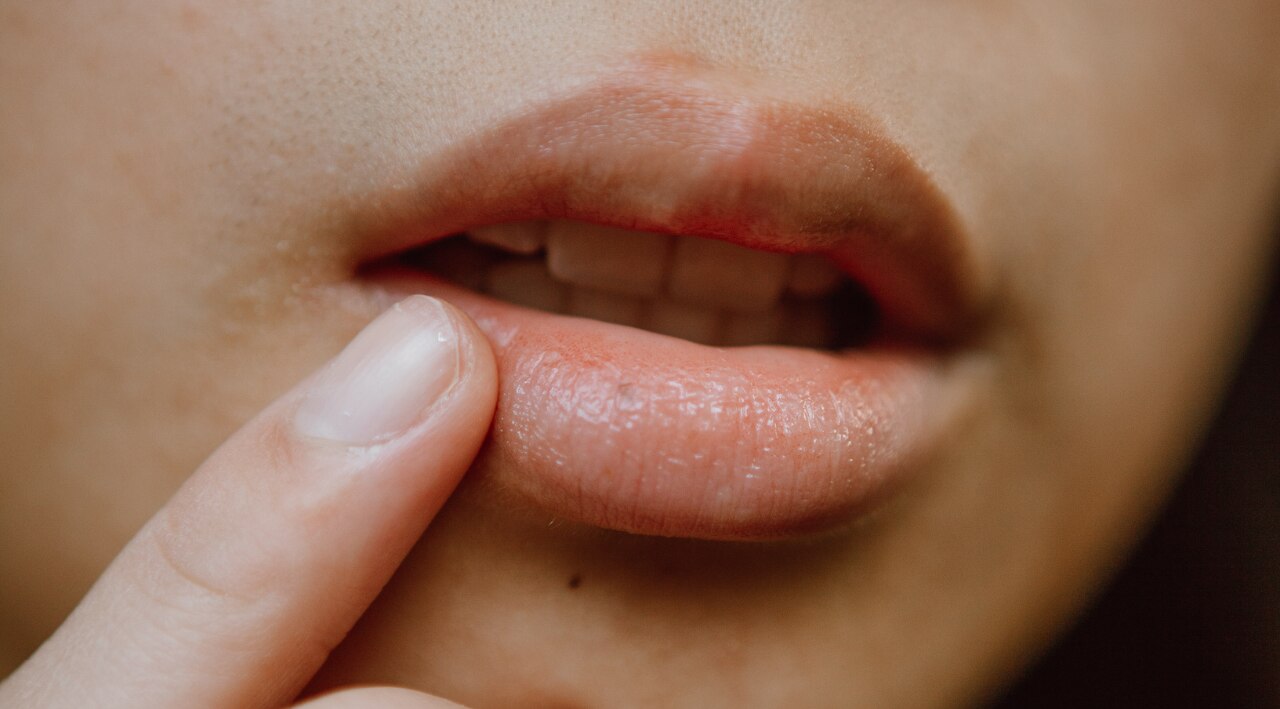 Dry and Chapped Lips: Prevention Tips