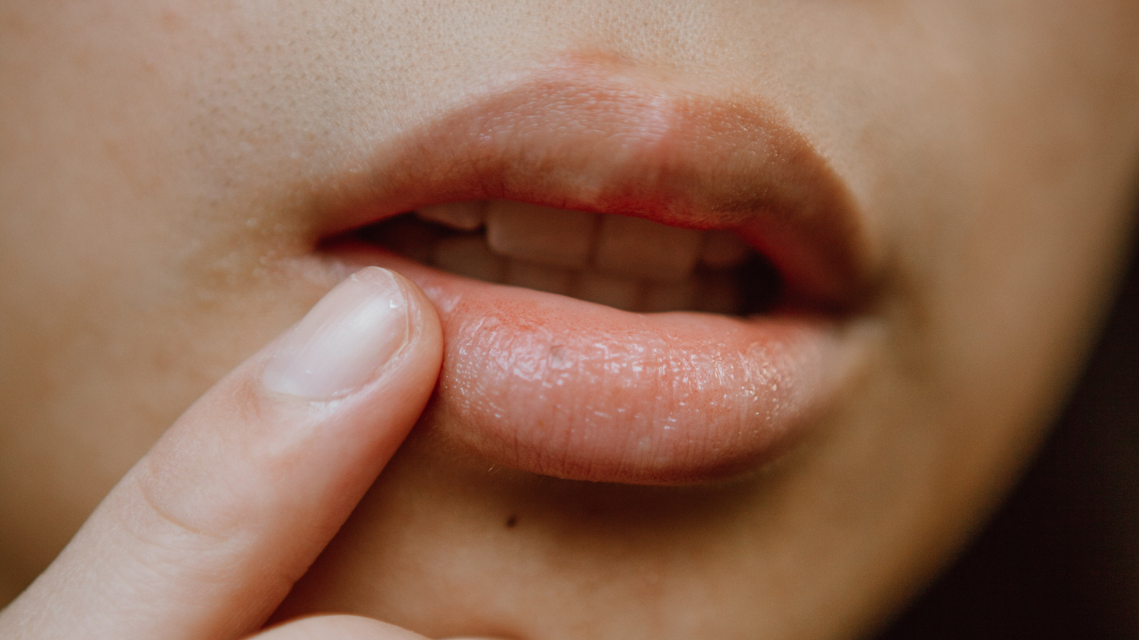 Dry and Chapped Lips: Prevention Tips