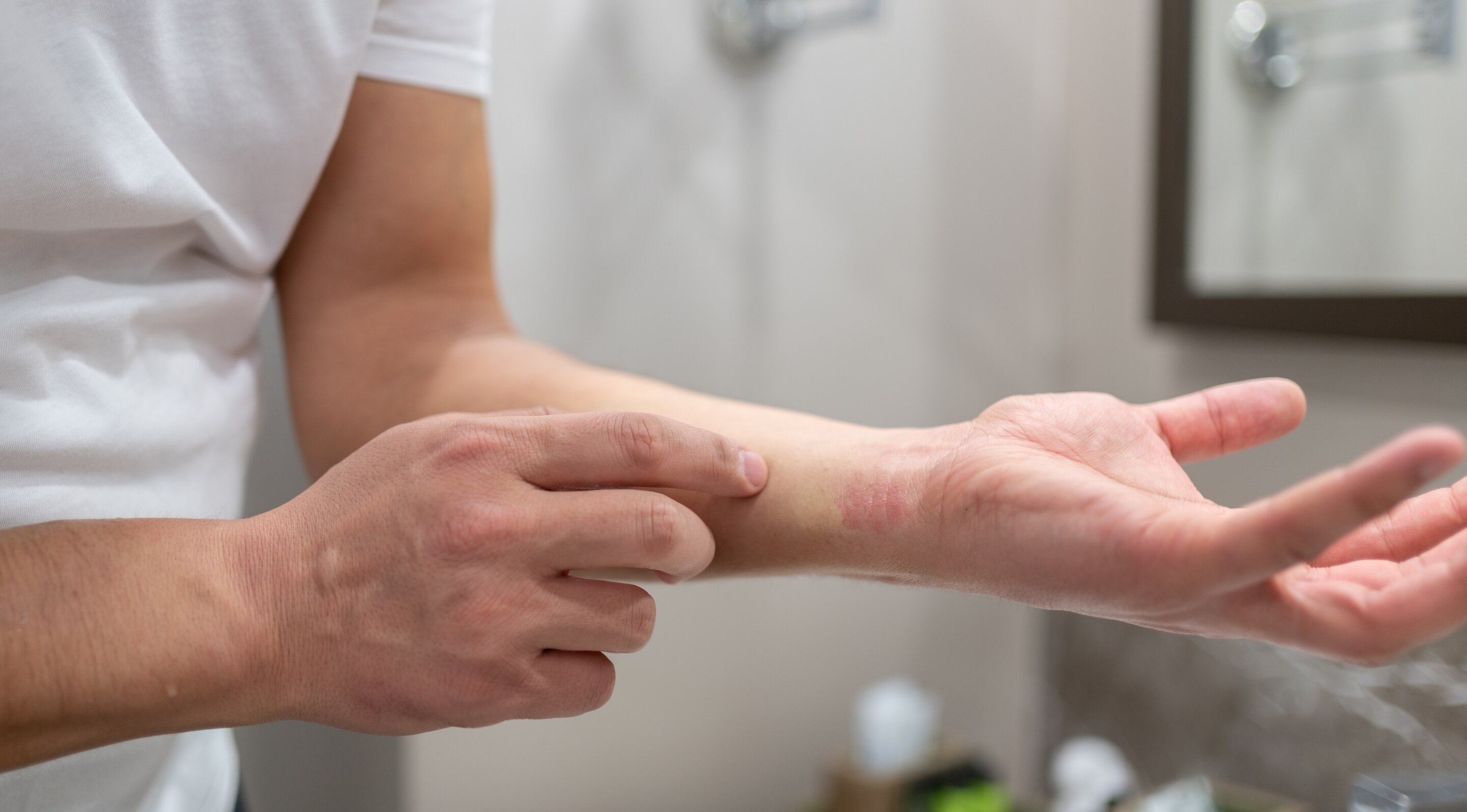 Allergic Reactions:
