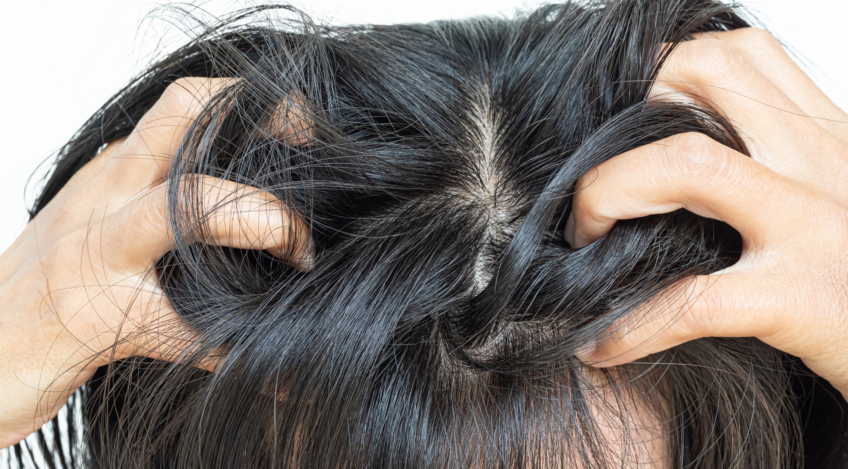 Mild Scalp Irritation: