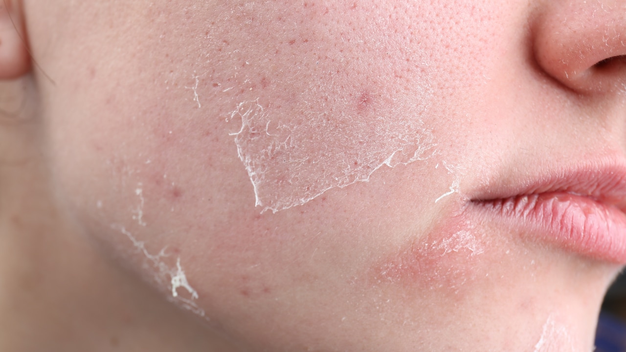 What Causes Dry Skin?