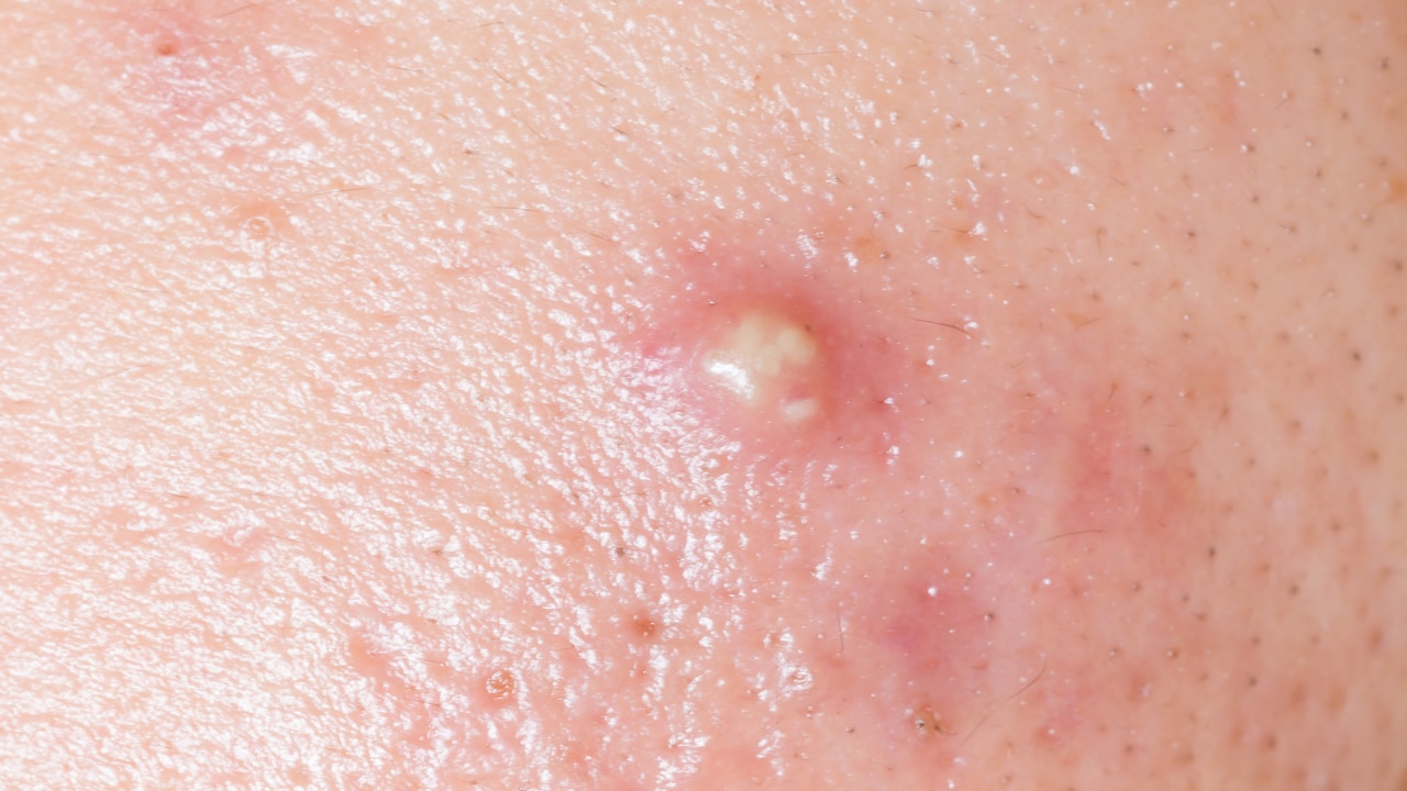 Does Sugar Cause Acne? (The Definitive Link)