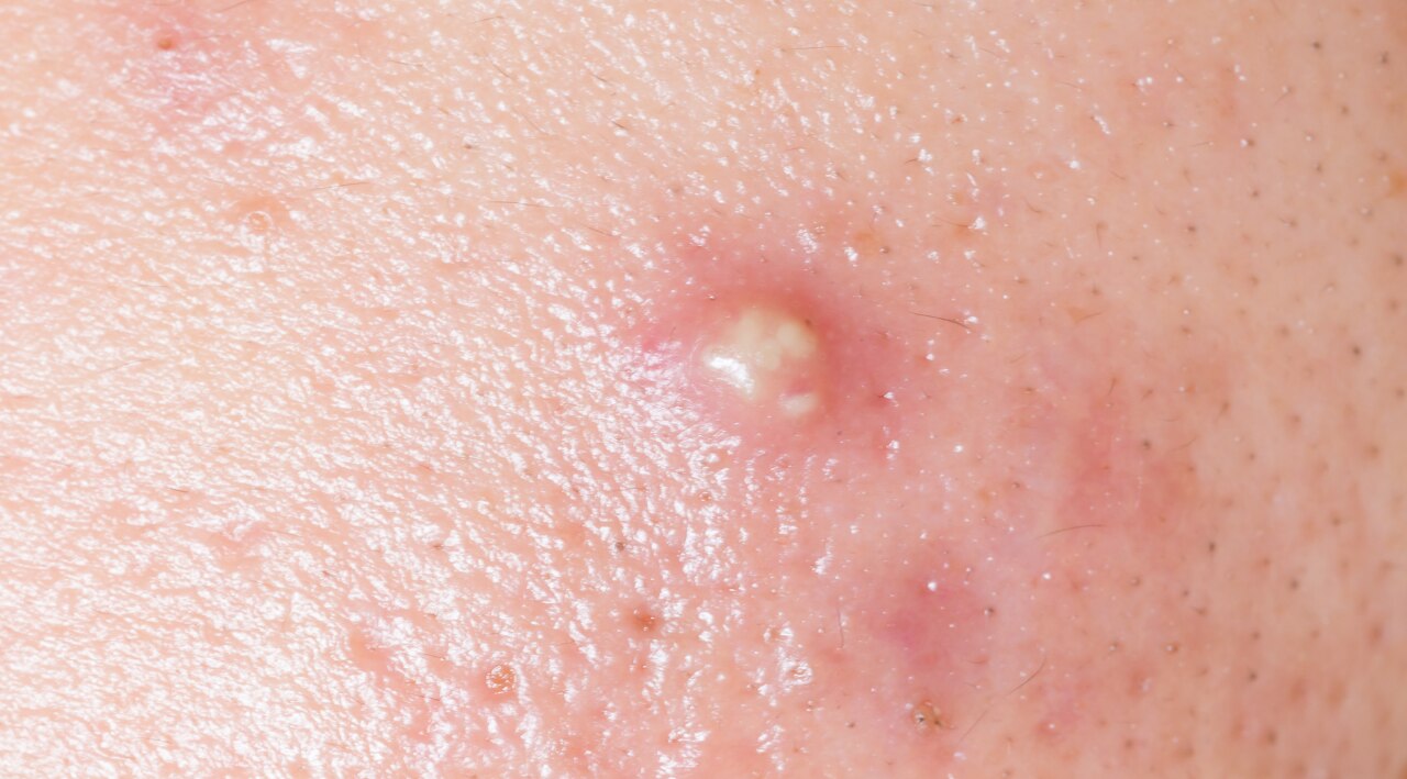 Does Sugar Cause Acne? (The Definitive Link)