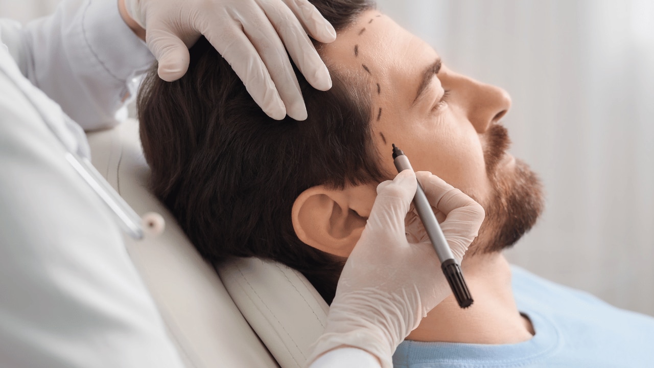 Hair Transplant (Follicular Unit Extraction/FUE or Follicular Unit Transplantation/FUT):