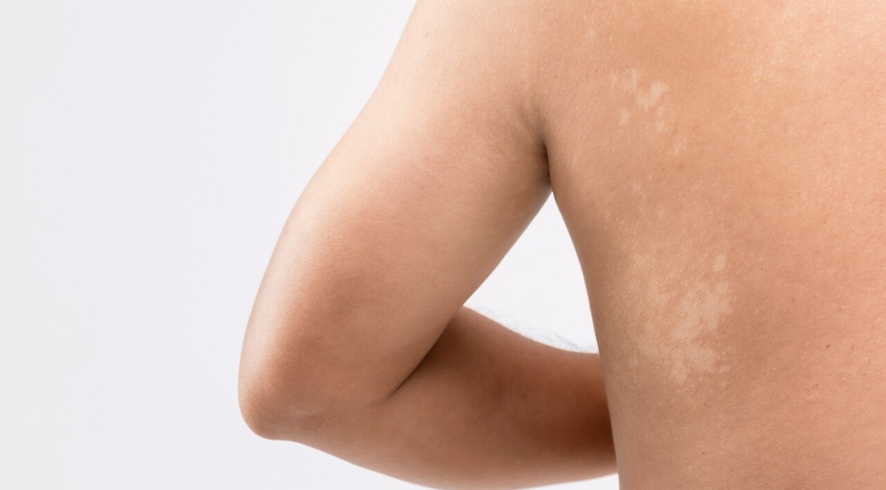 Pityriasis Alba: