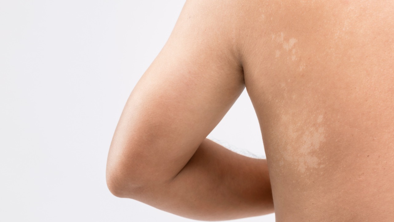 Pityriasis Alba: