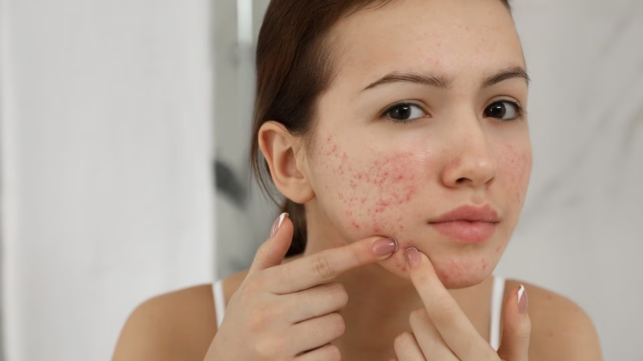 Persistent Acne Around The Same Time Each Month