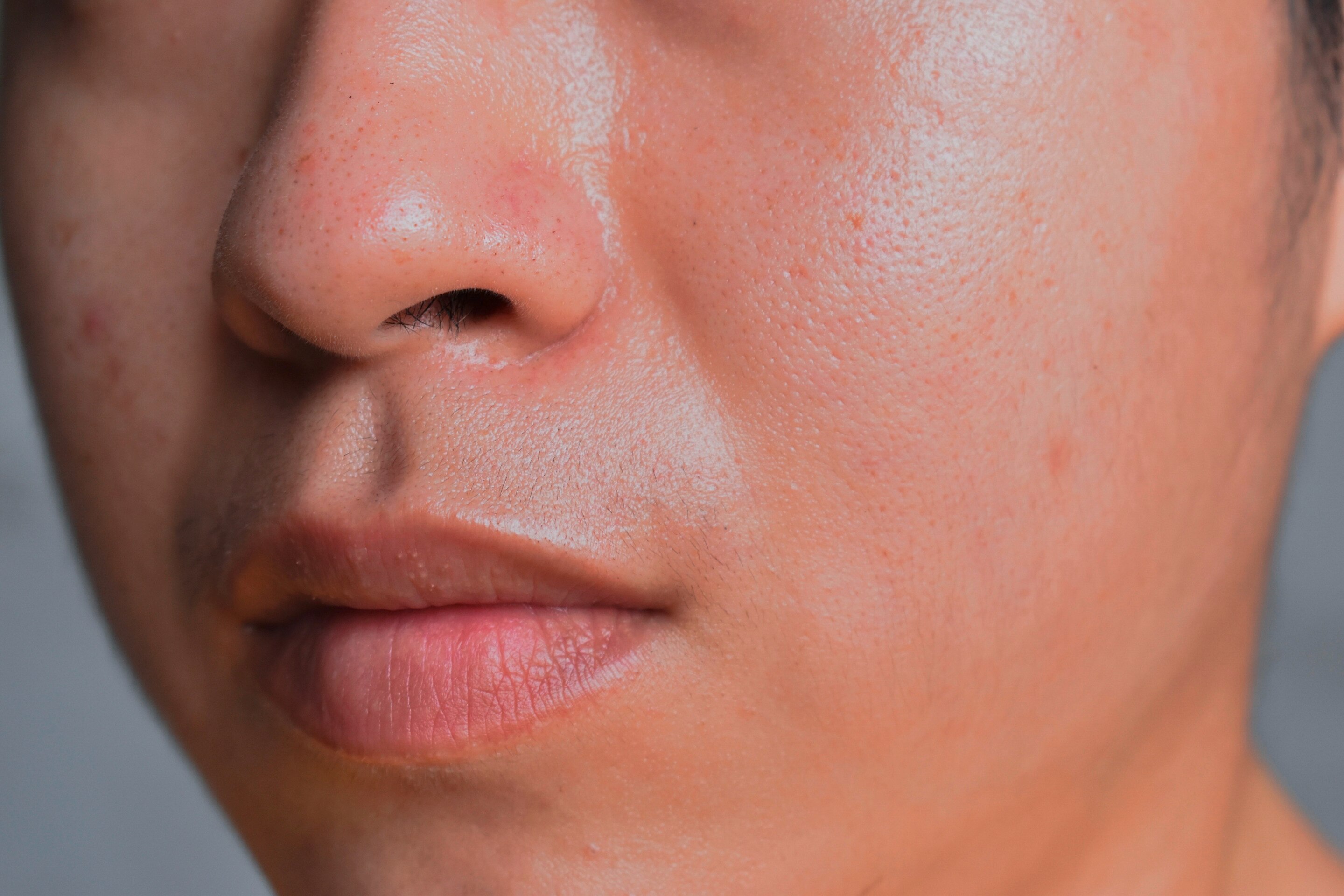 Closeup of an Asian man with oily skin.