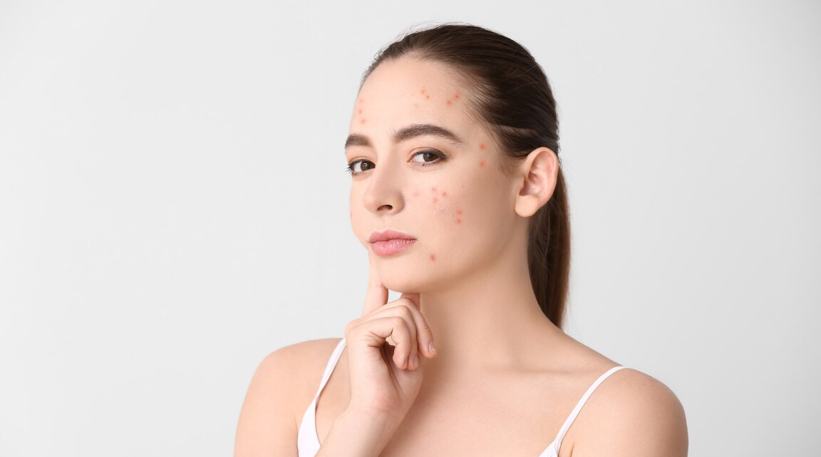 Cortisol Face and How Stress Affects Skin