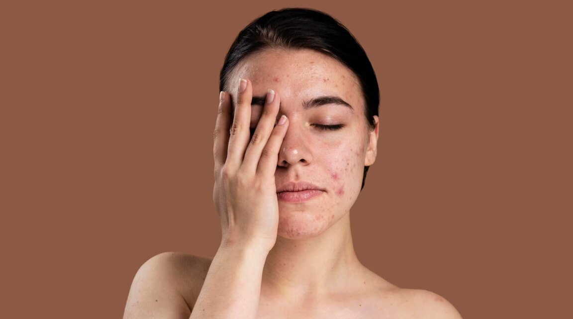 Best Pigmentation Removal Creams for Even Skin Tone