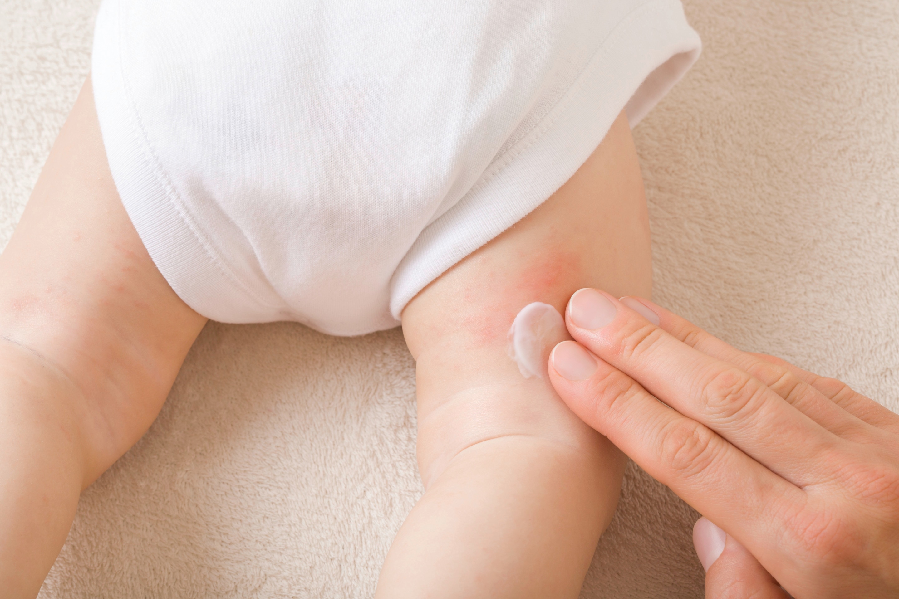 Ibu mengoleskan krim lembut pada kulit bayi yang mengalami bentol merah di area lipatan kaki.