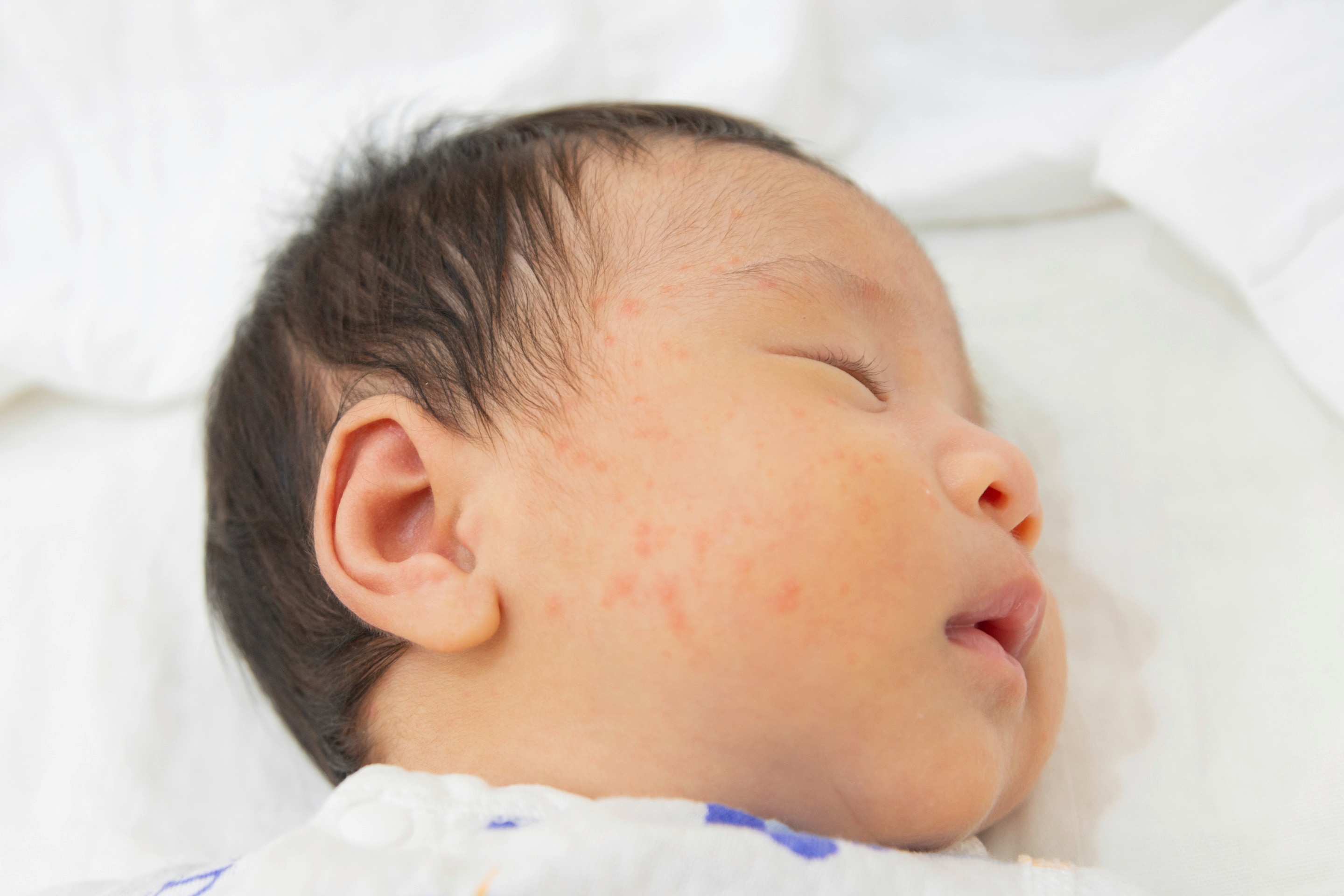 Bayi baru lahir sedang tidur dengan ruam kemerahan berupa bentol merah di pipi dan wajah.