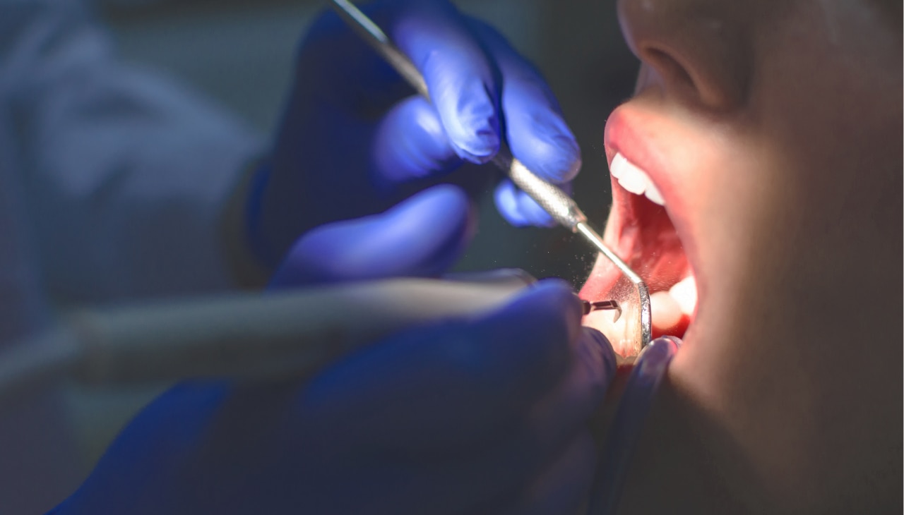 Professional Whitening vs Home Remedies