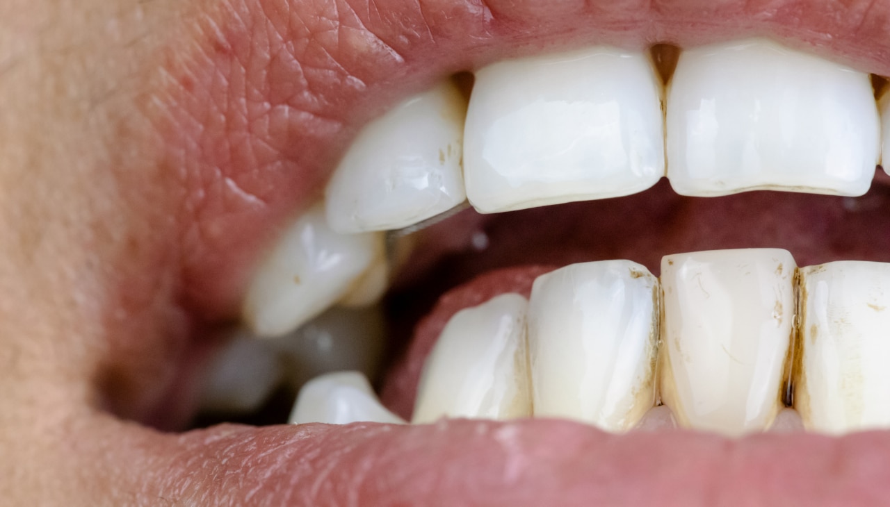 What Causes Teeth Staining?