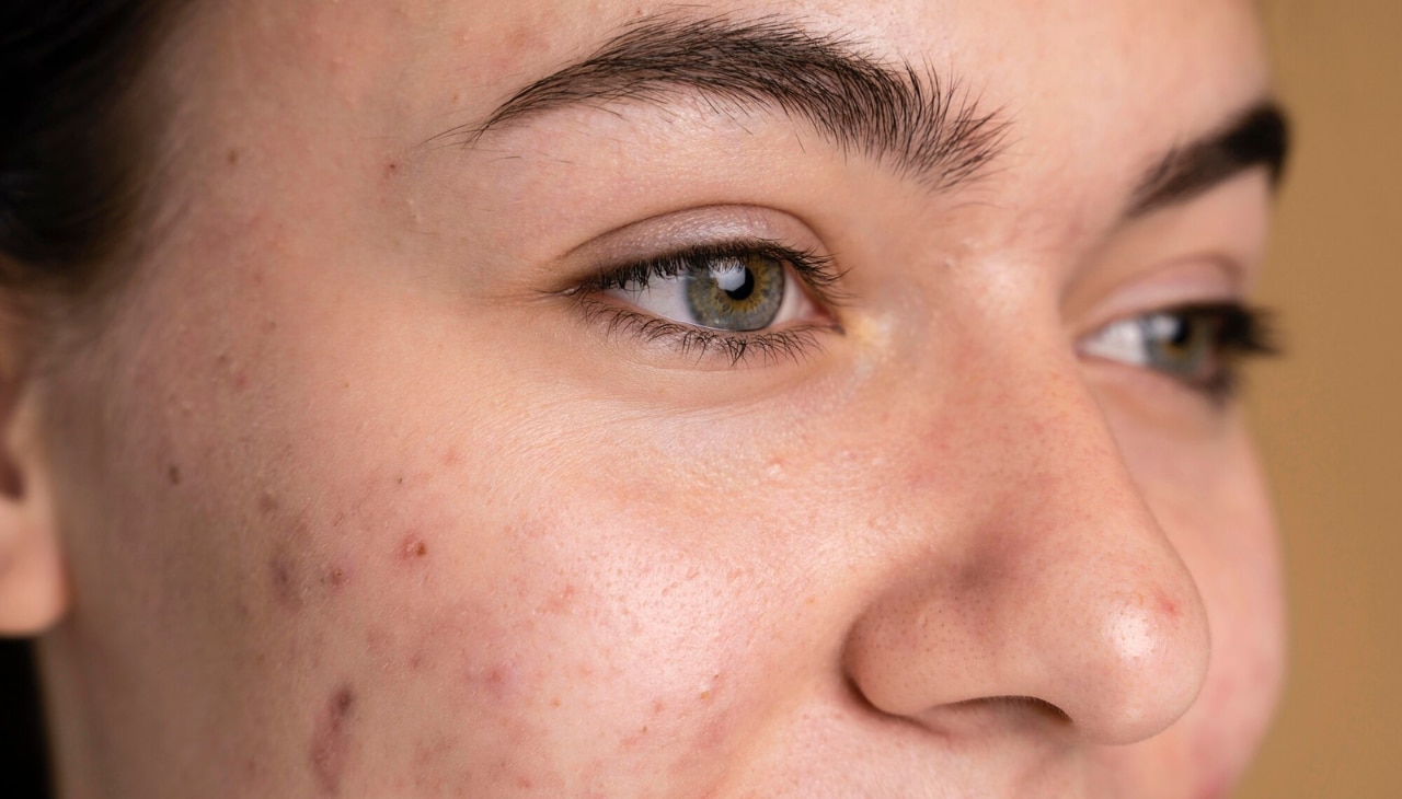 Benefits of Treating Dark Spots Early