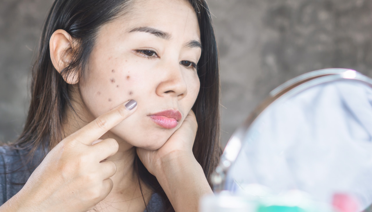 Causes of Dark Spots on the Face