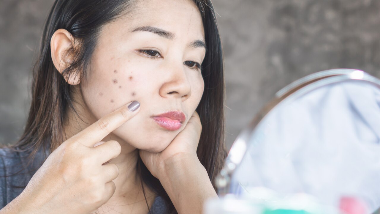 Causes of Dark Spots on the Face