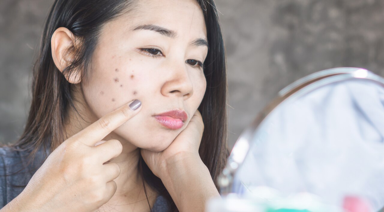 Causes of Dark Spots on the Face