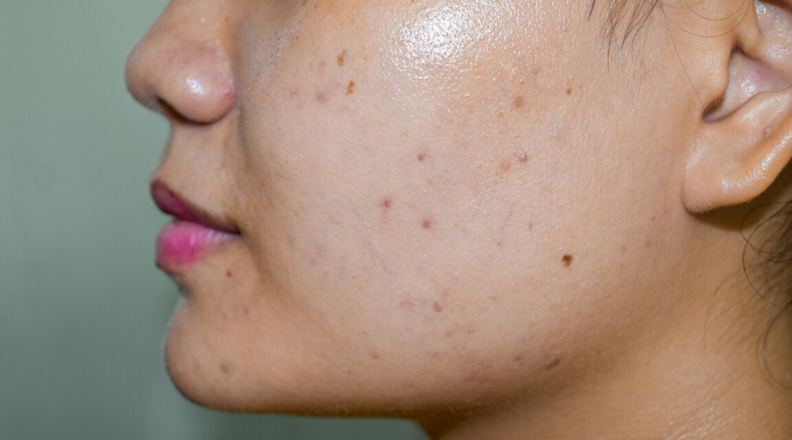 Causes and Treatments for Dark Spots on the Face