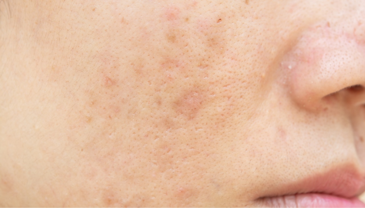 What Are Dark Spots?