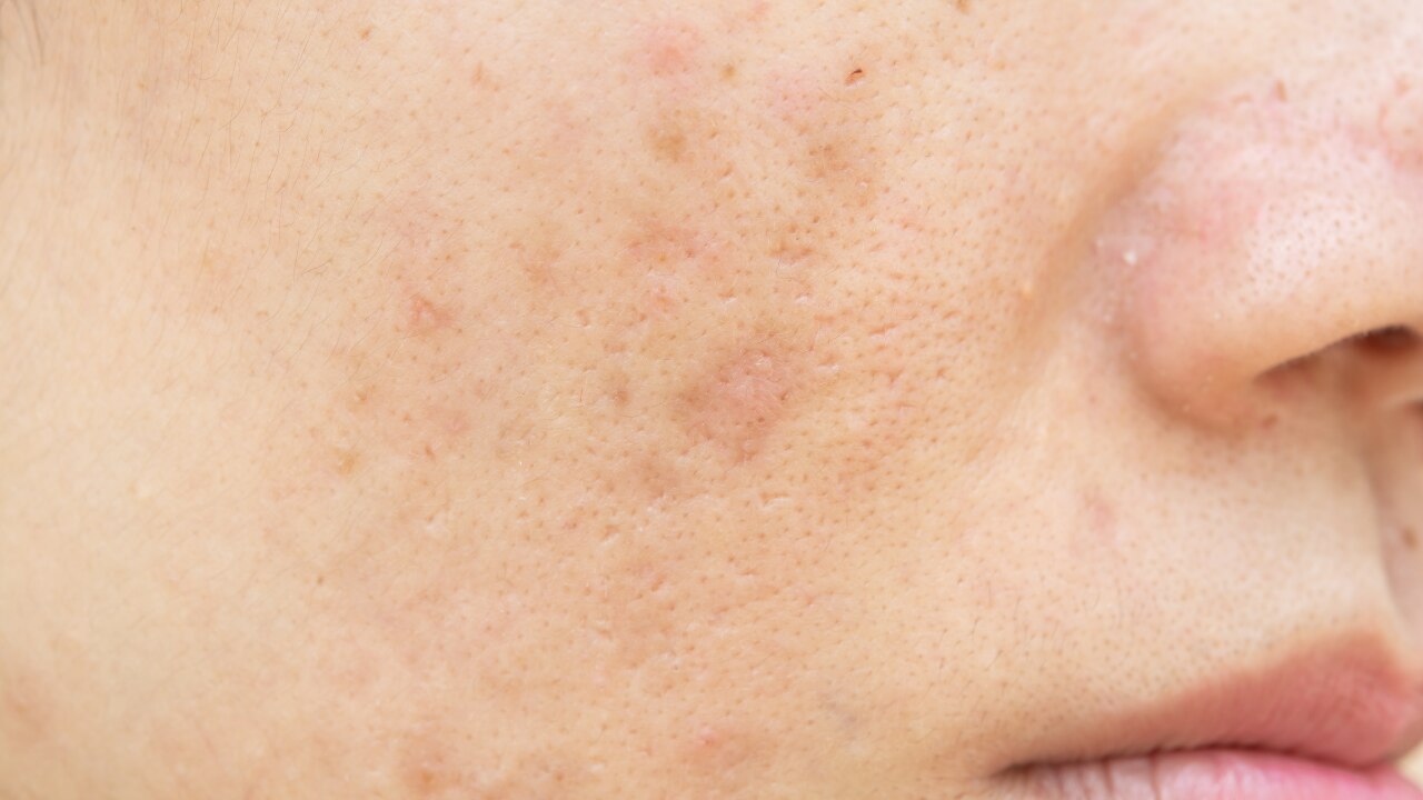 What Are Dark Spots?